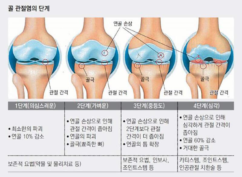 골 관절염의 단계